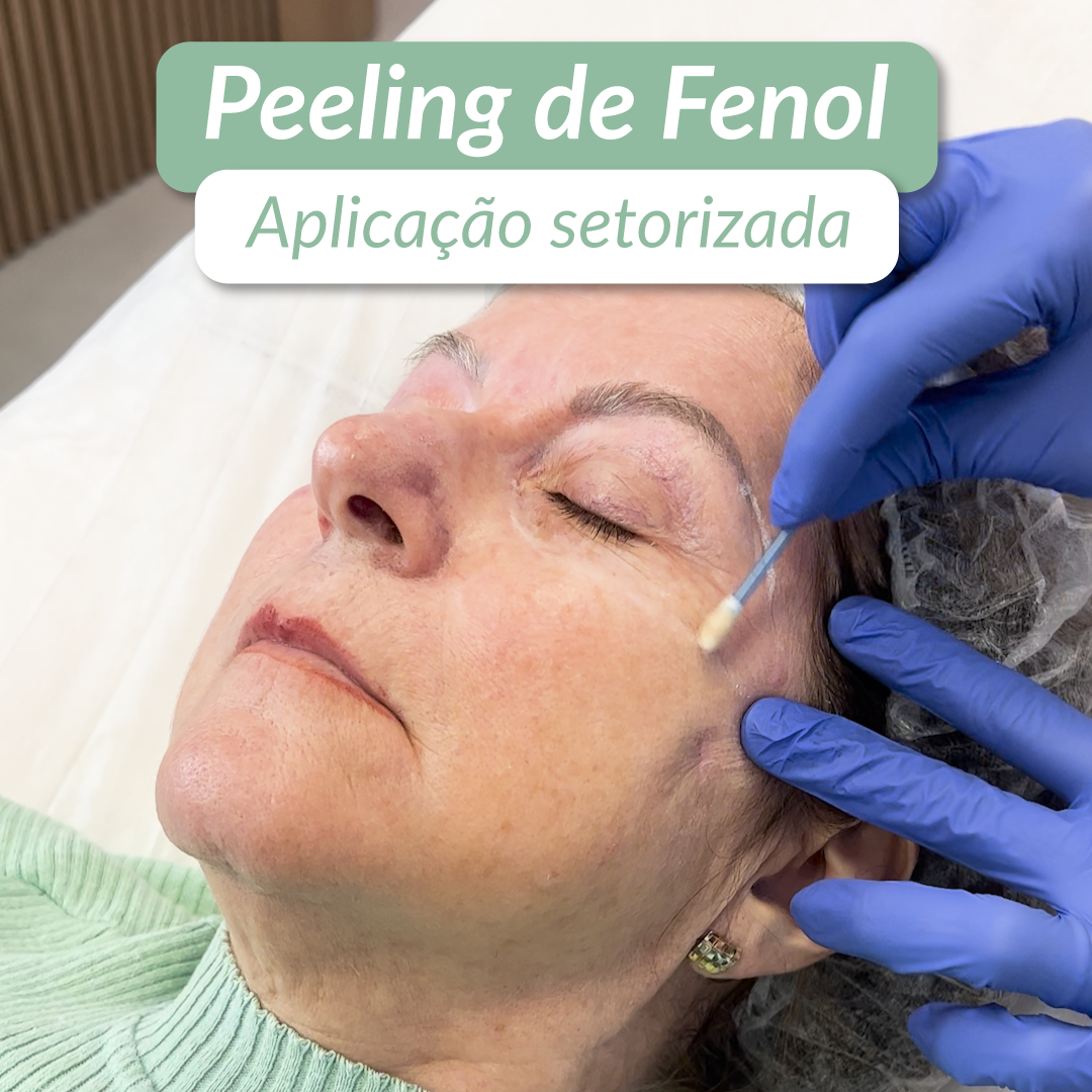 Afinal, o que é Peeling de Fenol?