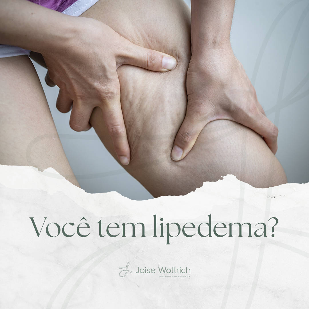 Você tem lipedema?