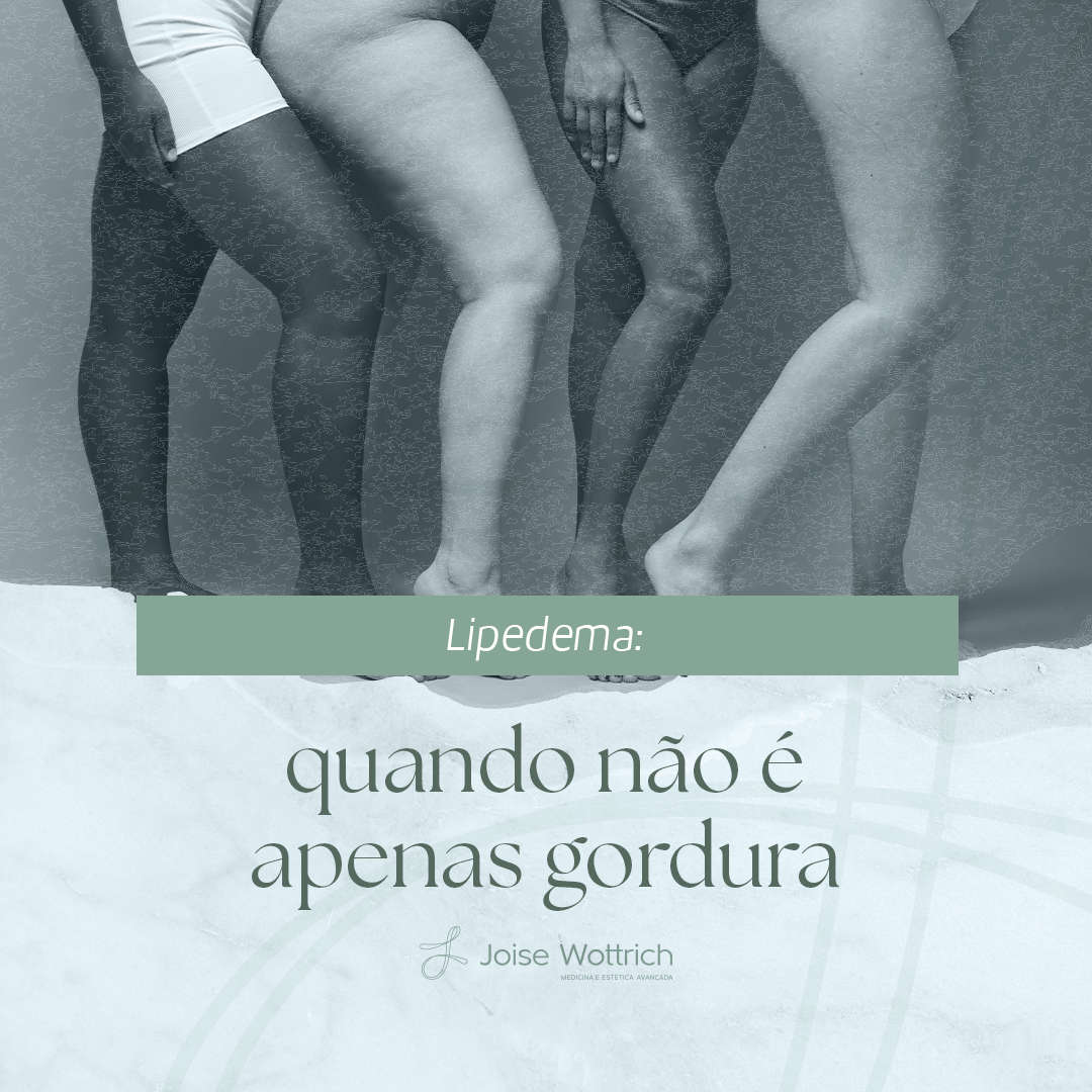 Lipedema: quando não é apenas gordura
