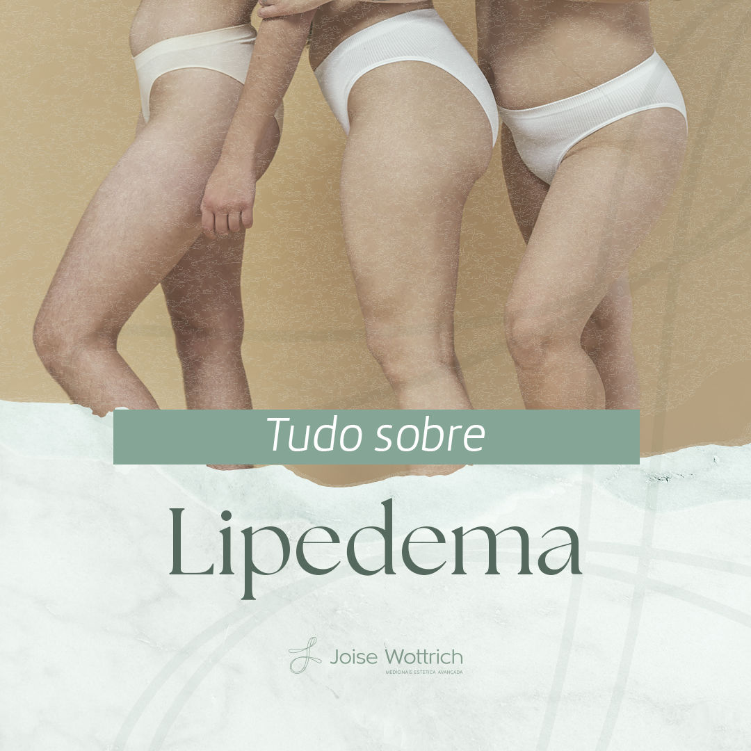 Tudo sobre Lipedema